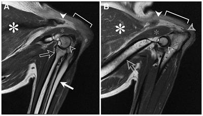 Case report: Nonsimultaneous bilateral triceps tendon rupture and surgical repair in a healthy dog